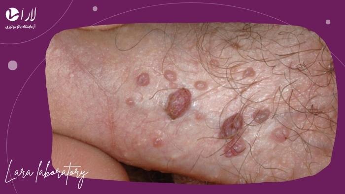 چرا آزمایش HPV برای مردان مهم است؟ چرا آزمایش HPV برای مردان مهم است؟
