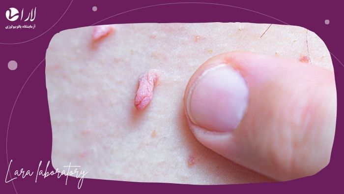 تست HPV مقعدی و دهانی